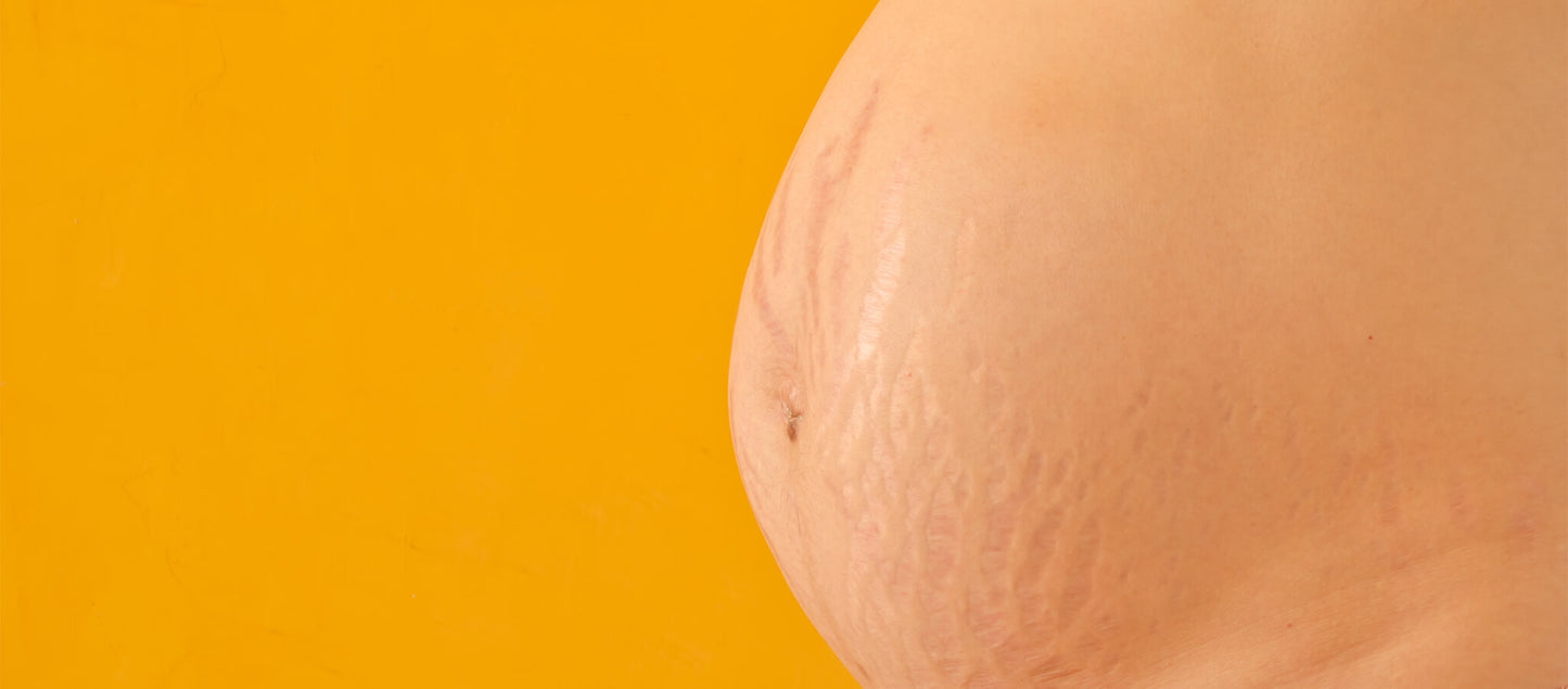 Why do some women get stretch marks and others don't?